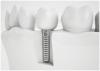 Photo for Osseointegration Implants Market Trends Research And Projections For 2018-2026