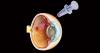 Photo for Macular Edema Treatment Market Boosting The Growth: Market Dynamics And Trends, Efficiencies Forecast 2026