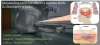 Photo for Gamma knife radio surgery at low cost in India