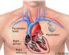 Photo for Check Pacemaker Surgery Cost in India - Credihealth