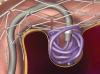 Photo for Neuroendovascular Coil Market Is Booming Across the Globe Explored in Latest Research 2018-2026
