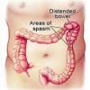Photo for Global Irritable Bowel Syndrome Treatment Market with present Situation and Forecast To 2026