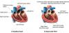 Photo for Pulmonary Arterial Hypertension (PAH) Market Current Industry Status, Target Audience,Top Key Players