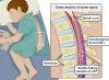Photo for Cerebral Spinal Fluid (CSF) Market Analysis and Value Forecast Snapshot by End-use Industry 2019-2025