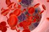 Photo for Myeloproliferative Neoplasms Treatment Market Accelerates Business to Gain High Revenue during 2018-2026