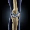 Photo for Knee Implants Market - Size, Share, Outlook, and Opportunity Analysis, 2018-2026