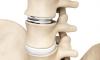 Photo for Global Cervical Total Disc Replacement Devices Industry Trends, Status, Benefits, growth and productivity