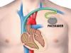 Photo for Implantable Cardiac Pacemaker Market Competitors With New Entrants