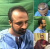 Photo for Hair Transplant In Lahore