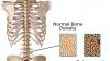 Photo for Anti-Osteoporosis And Fracture Healing Market Evolution, Forecast, Analysis by Vendors, Challenges To 2026
