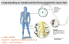 Photo for Understanding an Intrathecal Pain Pump Implant for Spine Pain, India