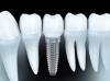 Photo for Global Dental Implants Market Overview, Industry Top Manufactures, Market Size, Industry Growth Analysis and Forecast: 2026