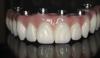 Photo for Osseointegration Implants Market Is Expected To Have The Highest Growth Rate During The Forecast Period 2026