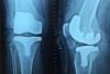 Photo for Bone Graft and Substitutes Market - Trends, Analysis and Forecast to 2025