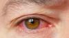 Photo for Dry Eye Syndrome Treatment Market Covering Developing Trends, Major Highlights With Global Analysis and Forecast By 2026