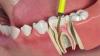 Photo for Root Canal Treatment Clifton NJ