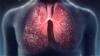 Photo for Cystic Fibrosis Market By Worldwide Analysis, Estimation, Industry Applications, Key Growths 2018 To 2026