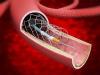 Photo for Cerebral Vascular Stent Market Analysis and Value Forecast Snapshot by End-use Industry 2019-2025