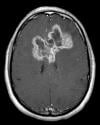 Photo for Glioblastoma Multiforme Market Accrues Phenomenally by 2026 with a Staggering CAGR