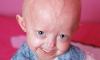 Photo for Hutchinson-Gilford Progeria Treatment Market - Advance Modifications in Treatment By Types And Outlook Till 2026