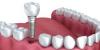 Photo for Dental Implants Market 2018 Professional Survey Report; Industry Growth, Shares, Opportunities and Forecast to 2026