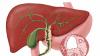 Photo for Primary Biliary Cholangitis Treatment Market - Size, Share, and Outlook, 2018-2026