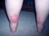 Photo for Vasculitis Treatment Market – Global Industry Insights, Trends, Outlook, and Opportunity Analysis, 2018-2026