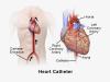 Photo for Demand for Cardiac Catheters and Guidewires to Rise Significantly from Key End-use Industry Sectors by 2025