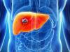Photo for Liver Cancer Therapeutics Market Pipeline Insight and Therapeutic Assessment Reviewed by 2018-2026