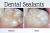 Photo for Protect Your Teeth with Dental Sealants