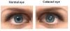 Photo for Cataract Treatment In Mumbai