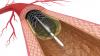 Photo for Bio-engineered Stent Market Global Industry Size, share, Outlook, and Forecast 2018-2026