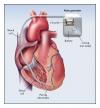 Photo for Implantable Cardioverter-defibrillators Market – Global Industry Insights, Trends, Outlook, and Opportunity Analysis, 2018-2026
