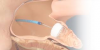 Photo for Occlusion Removal Devices Market Revenue, Outlook, Segment, Competitive landscape and Forecast 2019