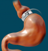 Photo for Bariatric Surgery Market: Latest Innovations, Drivers, Restraints, Challenges and Key Events in the industry by 2023