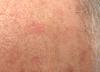 Photo for Actinic Keratosis Treatment Market SWOT Analysis, Major Key Players Revenue, Analysis and Forecasts- 2024