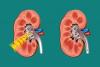 Photo for Kidney Stones Management Devices Market Global Insights, Future Trend & Forecast to 2021