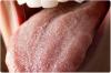 Photo for Candidiasis Market is Highly Competitive And Vibrant With The Major Key Players