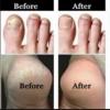 Photo for Get Rid Of Toenail Fungus