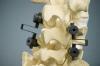 Photo for Spinal Fusion Devices Market Estimated to Record Highest CAGR by 2026