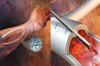 Photo for Vascular Grafts Market Leading Players Analysis, Market status and Forecast Up To 2026