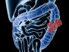 Photo for Colonoscopy Cost | Colonoscopy Cost in Chennai - Credihealth