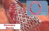 Photo for Coronary Stents Market to Surpass US$ 13.0 billion by 2026