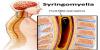 Photo for Syringomyelia Market Treatment Usage Pattern and Market Size with Molecule Type and Mechanism of Action Report