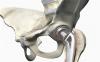 Photo for Bone Replacement Products Market to Witness a Pronounce Growth by 2026