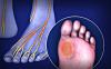 Photo for Diabetic Neuropathy Market Size & Share to See Modest Growth Through 2026
