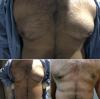 Photo for Gynecomastia Surgery With Liposuction In Lahore