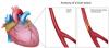 Photo for Trends in Acute Coronary Syndrome (ACS) Market:  Investment Feasibility, Sales, Production by 2025