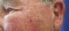 Photo for Actinic Keratosis Market  Trends, Outlook, and Opportunity Analysis, 2018 – 2026