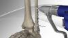 Photo for Analysis of Bone Repair Material Market in Global Industry: Demand, Growth Factors, Supply, Latest Rising Trend & Forecast to 2025